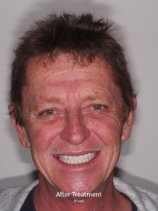 After Treatment from the Front